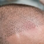 چطور متخصص خوب میکرواسکالپ پیدا کنیم؟ (نمونه کار، مدرک)